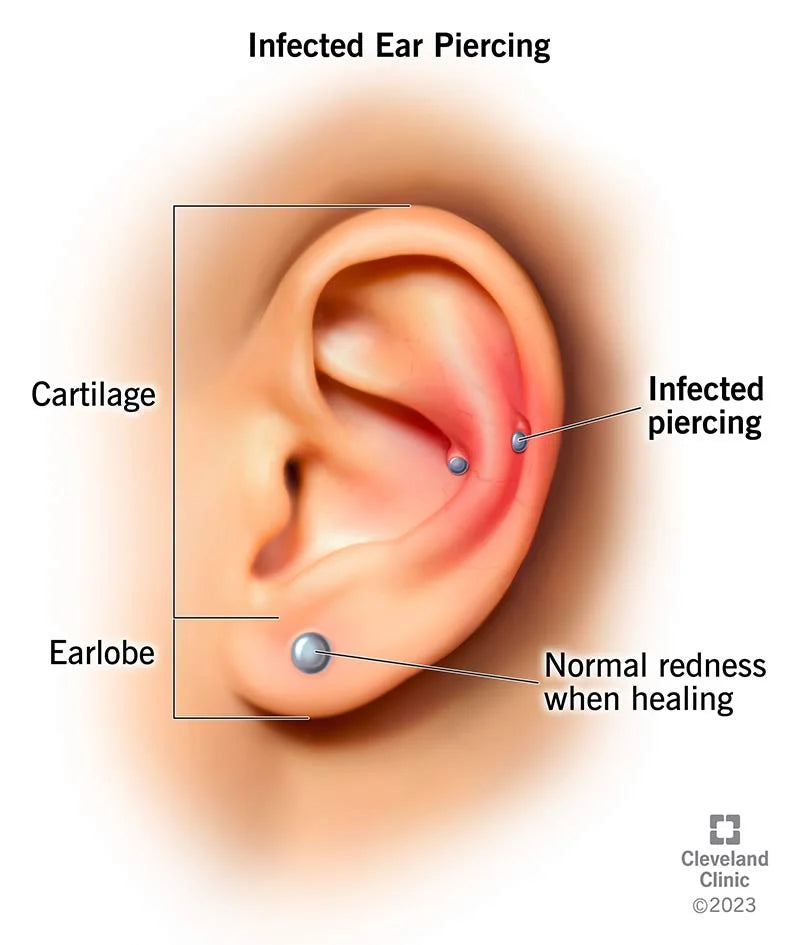 ¿Cómo tratar un piercing en la oreja infectado?