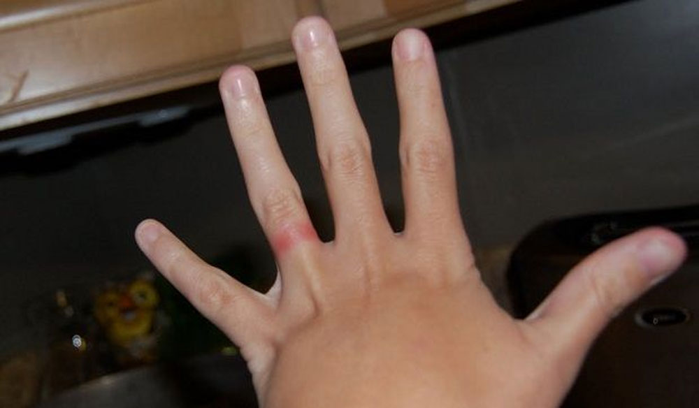 Can Men's Silver Rings Cause Skin Allergies?